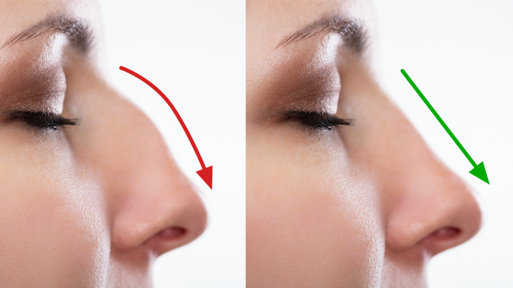 Niechirurgiczna korekta nosa 
